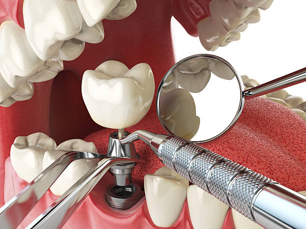 Best Emergency Dental Filling Replacement  in Okawvle, IL